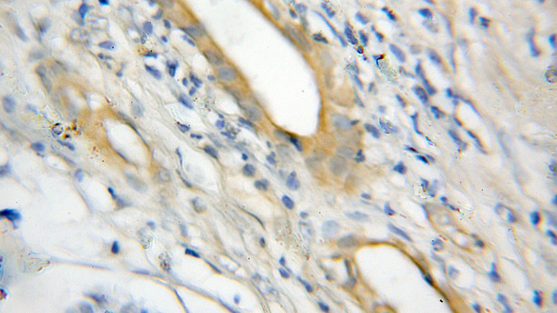 Immunohistochemical of paraffin-embedded human pancreas cancer using Catalog No:113241(NLRP1 antibody) at dilution of 1:50 (under 10x lens)