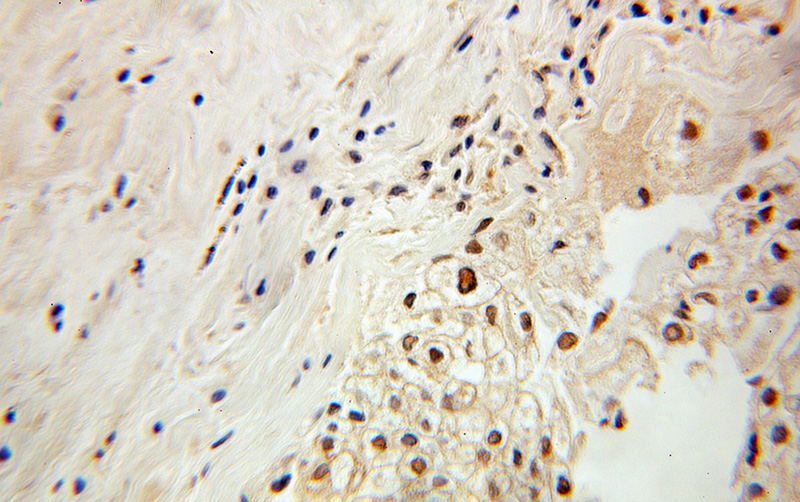 Immunohistochemical of paraffin-embedded human ovary tumor using Catalog No:113763(PDCD2 antibody) at dilution of 1:100 (under 10x lens)