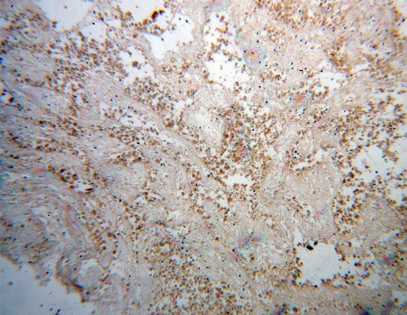 Immunohistochemical of paraffin-embedded human lung cancer using Catalog No:117218(BPIL1 antibody) at dilution of 1:100 (under 10x lens)