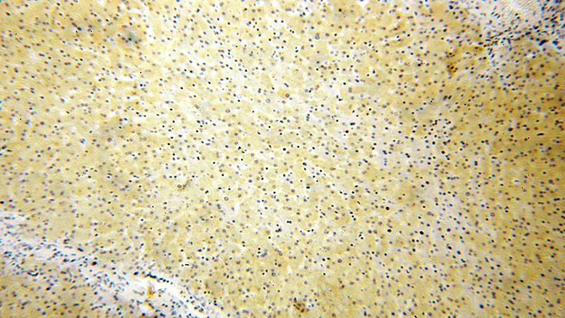 Immunohistochemical of paraffin-embedded human liver cancer using Catalog No:109686(CYP20A1 antibody) at dilution of 1:200 (under 10x lens)