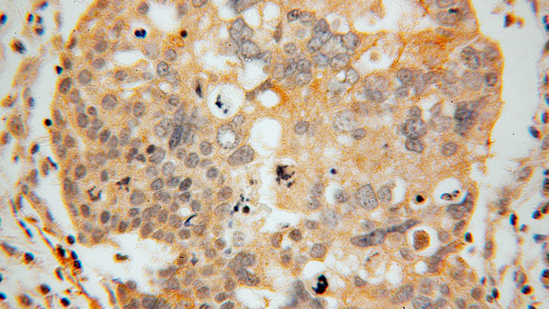 Immunohistochemical of paraffin-embedded human ovary tumor using Catalog No:111083(GLYATL1 antibody) at dilution of 1:100 (under 40x lens)