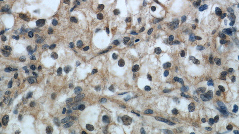 Immunohistochemical of paraffin-embedded human renal cell carcinoma using Catalog No:116009(TFEB antibody) at dilution of 1:50 (under 40x lens)