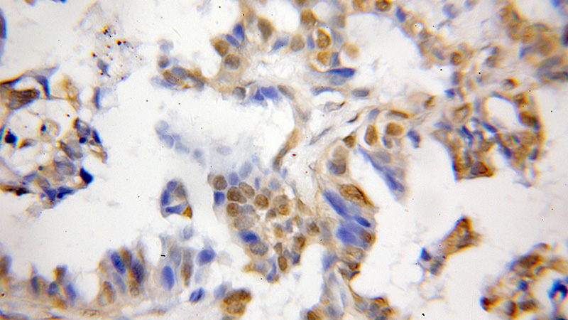 Immunohistochemical of paraffin-embedded human lung cancer using Catalog No:110064(DPF2 antibody) at dilution of 1:50 (under 10x lens)