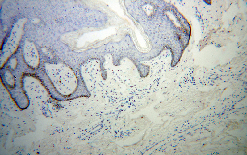 Immunohistochemical of paraffin-embedded human skin cancer using Catalog No:112875(MSRA antibody) at dilution of 1:50 (under 10x lens)