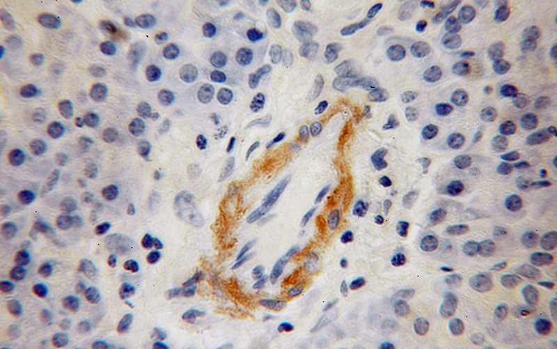 Immunohistochemical of paraffin-embedded human pancreas cancer using Catalog No:109717(CDO1 antibody) at dilution of 1:100 (under 10x lens)