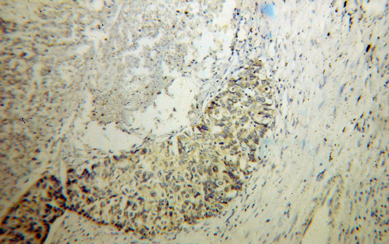 Immunohistochemical of paraffin-embedded human liver cancer using Catalog No:112779(MTHFS antibody) at dilution of 1:100 (under 10x lens)