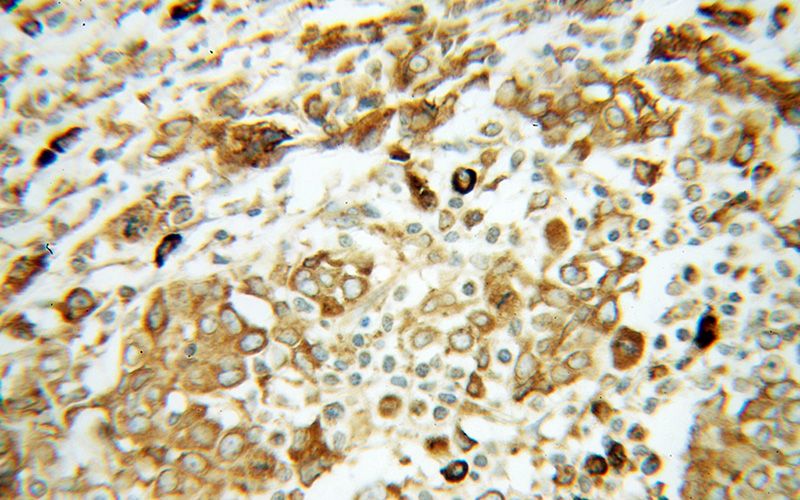 Immunohistochemical of paraffin-embedded human breast cancer using Catalog No:111223(HSP90B1 antibody) at dilution of 1:100 (under 40x lens)