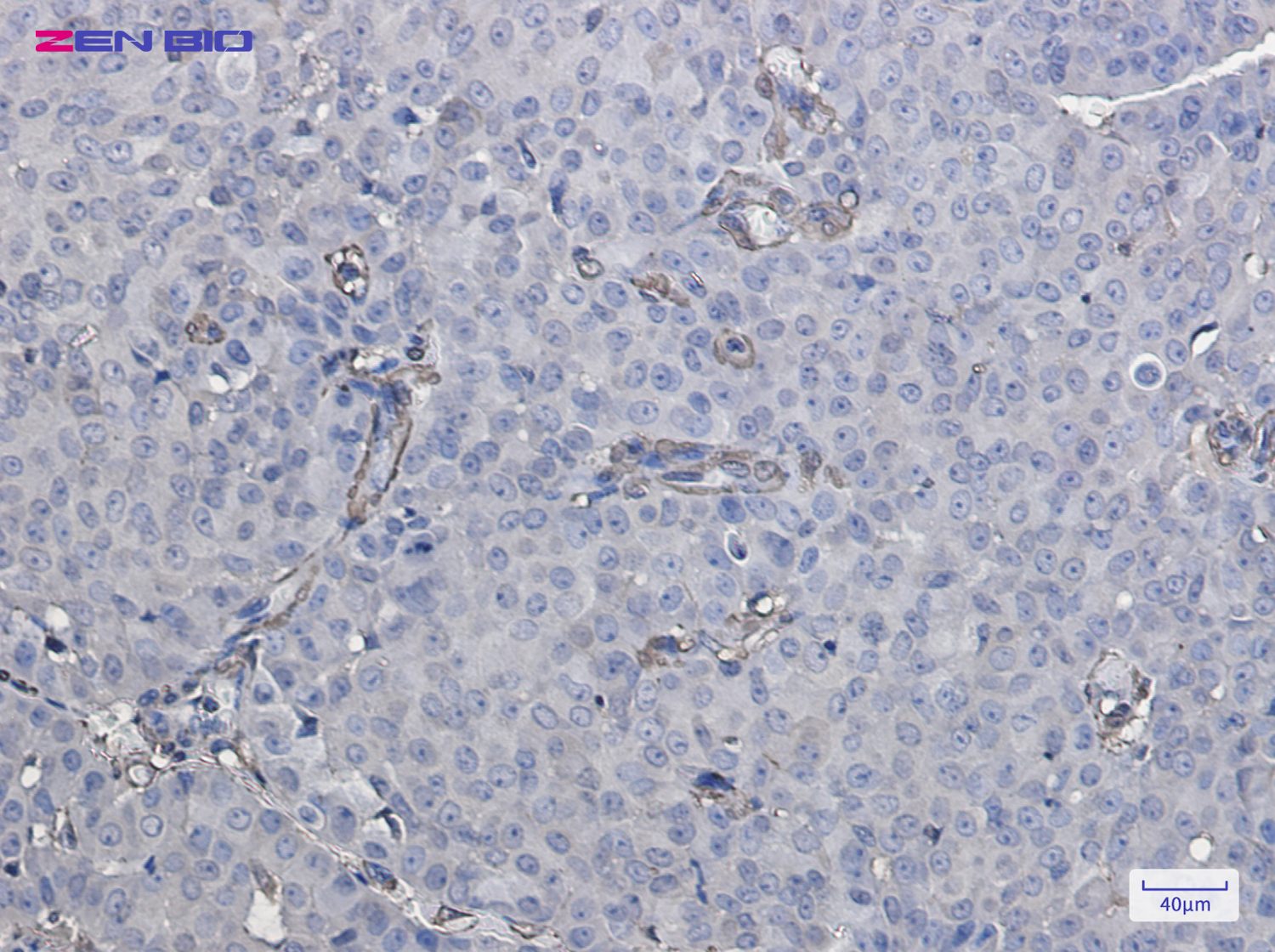Immunohistochemistry of Galectin 1 in paraffin-embedded Human breast cancer tissue using Galectin 1 Rabbit pAb at dilution 1/20