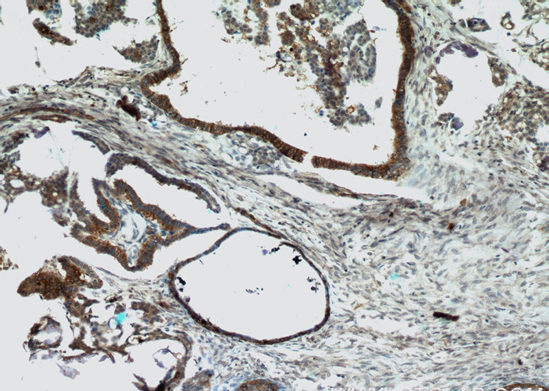 Immunohistochemical of paraffin-embedded human ovary tumor using Catalog No:109943(DIO1 antibody) at dilution of 1:50 (under 10x lens)
