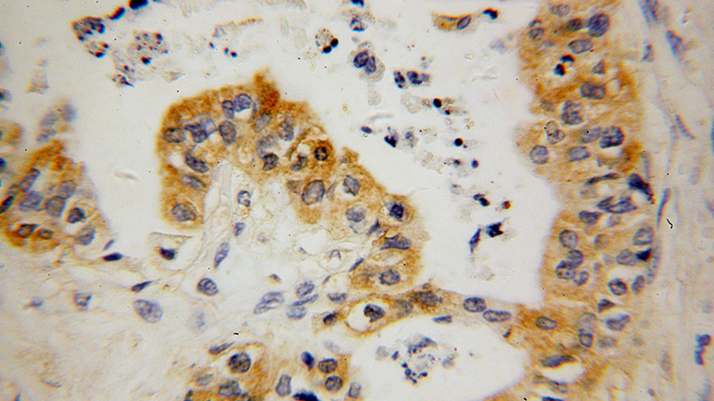 Immunohistochemical of paraffin-embedded human stomach cancer using Catalog No:111165(GSDMB antibody) at dilution of 1:50 (under 40x lens)