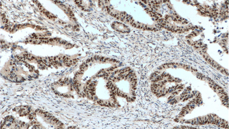Immunohistochemistry of paraffin-embedded human colon cancer tissue slide using Catalog No:107430(MSH2 Antibody) at dilution of 1:800 (under 10x lens). heat mediated antigen retrieved with Tris-EDTA buffer(pH9).
