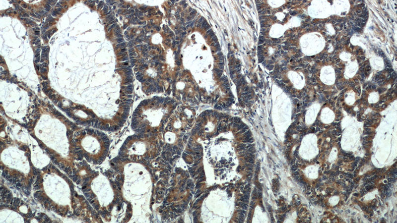 Immunohistochemical of paraffin-embedded human colon cancer using Catalog No:108701(C20orf30 antibody) at dilution of 1:50 (under 10x lens)
