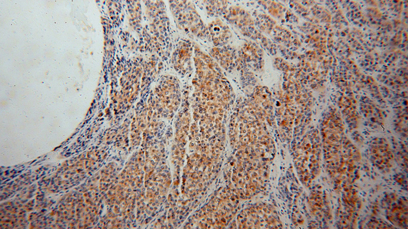 Immunohistochemical of paraffin-embedded human liver cancer using Catalog No:115228(SIGMAR1 antibody) at dilution of 1:50 (under 10x lens)
