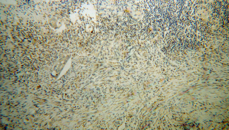 Immunohistochemical of paraffin-embedded human colon cancer using Catalog No:115074(SEC11A antibody) at dilution of 1:100 (under 10x lens)