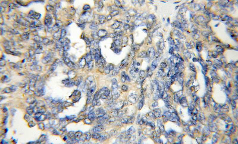 Immunohistochemical of paraffin-embedded human ovary tumor using Catalog No:107866(AP2A1 antibody) at dilution of 1:50 (under 10x lens)