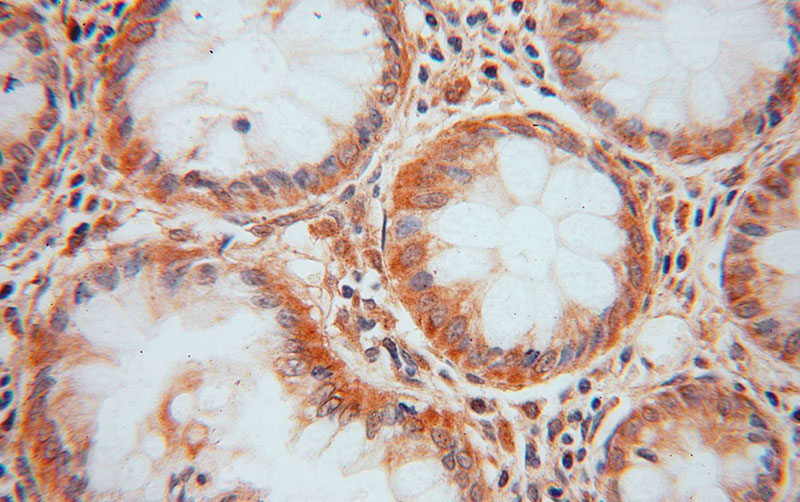 Immunohistochemical of paraffin-embedded human colon cancer using Catalog No:109769(DDAH2 antibody) at dilution of 1:50 (under 40x lens)