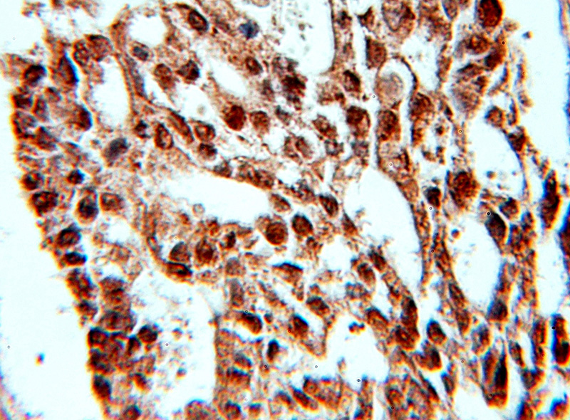 Immunohistochemical of paraffin-embedded human ovary tumor using Catalog No:114231(PRPF4 antibody) at dilution of 1:10 (under 10x lens)