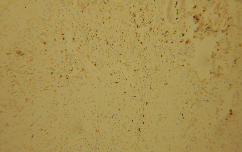 Immunohistochemical of paraffin-embedded human pancreas cancer using Catalog No:114003(POLI antibody) at dilution of 1:100 (under 10x lens)