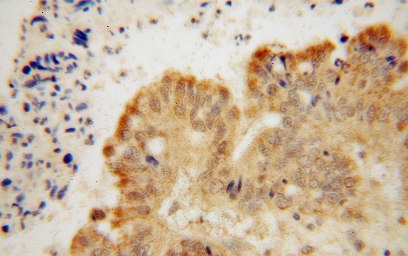Immunohistochemical of paraffin-embedded human colon cancer using Catalog No:109432(CNOT10 antibody) at dilution of 1:50 (under 40x lens)