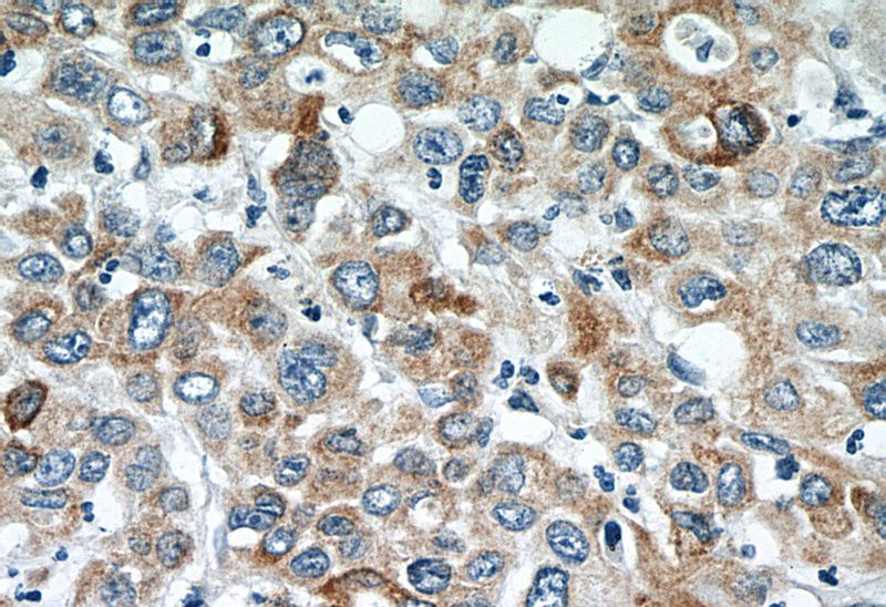 Immunohistochemistry of paraffin-embedded human stomach cancer slide using Catalog No:116181(TMEM25 Antibody) at dilution of 1:50