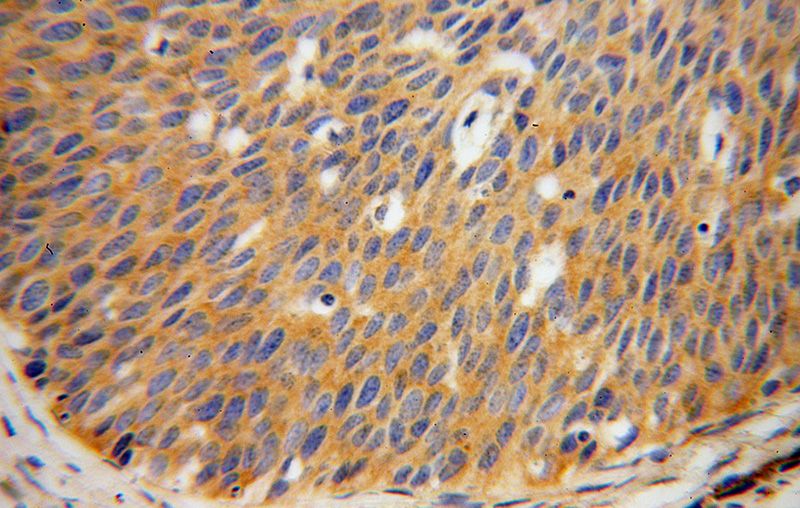 Immunohistochemical of paraffin-embedded human cervical cancer using Catalog No:107928(AKAP10 antibody) at dilution of 1:100 (under 40x lens)