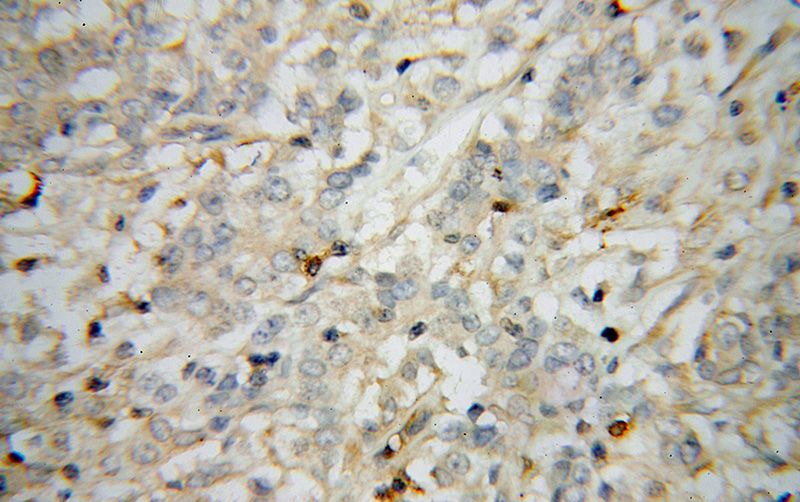 Immunohistochemical of paraffin-embedded human breast cancer using Catalog No:115686(STAT2 antibody) at dilution of 1:50 (under 40x lens)