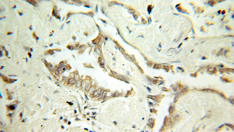 Immunohistochemical of paraffin-embedded human lung cancer using Catalog No:109664(CCND3 antibody) at dilution of 1:100 (under 10x lens)