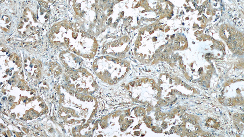 Immunohistochemical of paraffin-embedded human lung cancer using Catalog No:107035(CAV1 antibody) at dilution of 1:50 (under 10x lens)