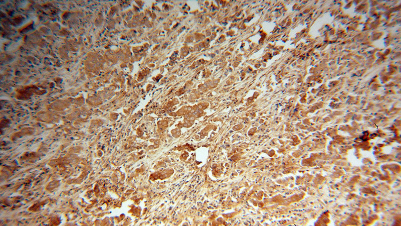 Immunohistochemical of paraffin-embedded human prostate cancer using Catalog No:113501(PAK6 antibody) at dilution of 1:100 (under 10x lens)