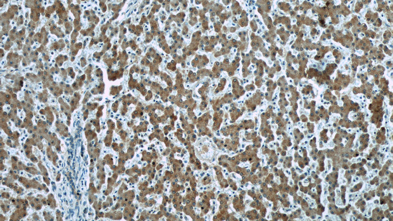 Immunohistochemistry of paraffin-embedded human liver tissue slide using Catalog No:107169(CFB Antibody) at dilution of 1:50 (under 10x lens)