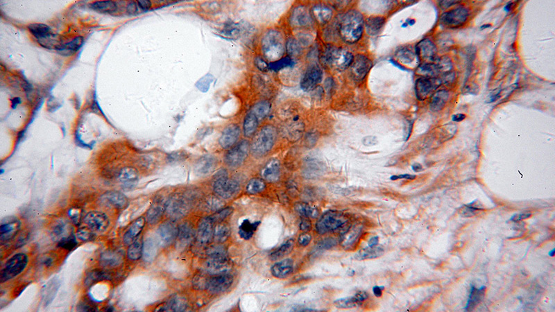 Immunohistochemical of paraffin-embedded human pancreas cancer using Catalog No:110819(GADD34 antibody) at dilution of 1:100 (under 40x lens)