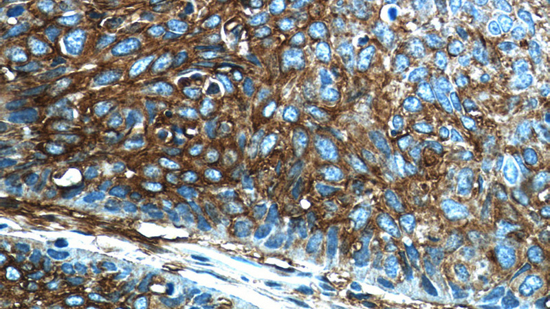 Immunohistochemistry of paraffin-embedded human lung cancer tissue slide using Catalog No:108033(APOL2 Antibody) at dilution of 1:200 (under 40x lens)