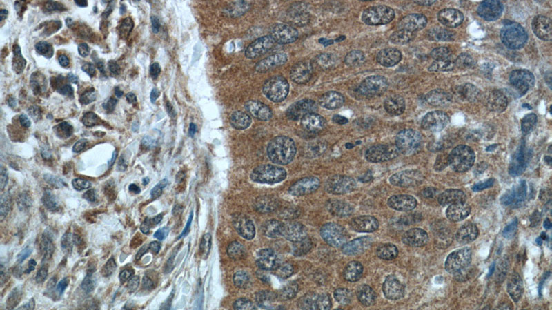 Immunohistochemistry of paraffin-embedded human cervical cancer tissue slide using Catalog No:113031(NCAPG Antibody) at dilution of 1:50 (under 40x lens)