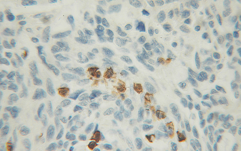 Immunohistochemical of paraffin-embedded human ovary tumor using Catalog No:112703(MMP23B antibody) at dilution of 1:100 (under 10x lens)