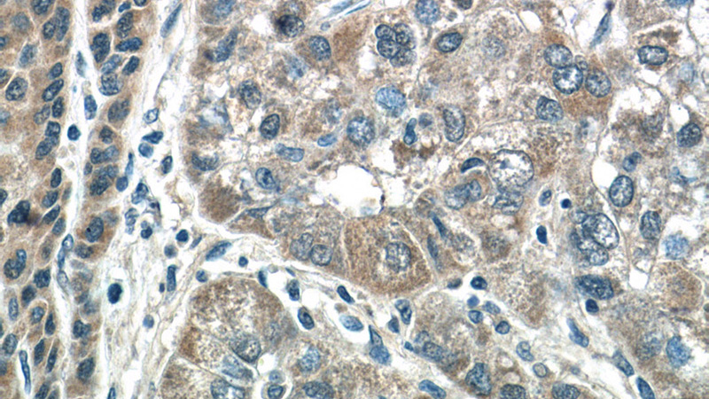 Immunohistochemistry of paraffin-embedded human liver cancer tissue slide using Catalog No:111760(IMP5 Antibody) at dilution of 1:50 (under 40x lens)