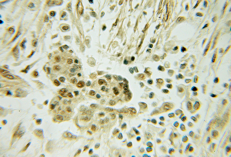 Immunohistochemical of paraffin-embedded human pancreas cancer using Catalog No:110104(DNAJC12 antibody) at dilution of 1:50 (under 10x lens)