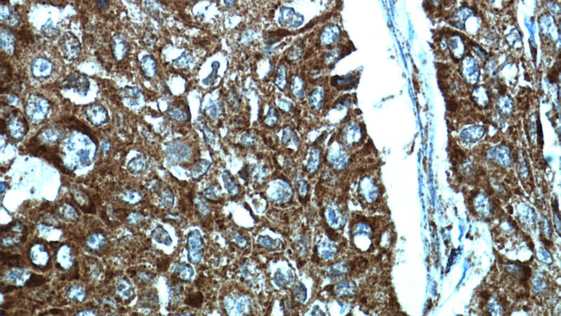 Immunohistochemical of paraffin-embedded human lung cancer using Catalog No:115731(STOML2 antibody) at dilution of 1:100 (under 40x lens)