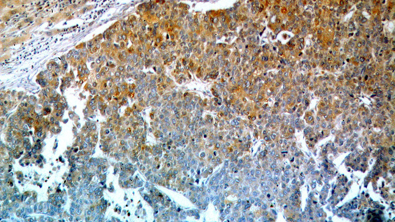 Immunohistochemical of paraffin-embedded human liver cancer using Catalog No:114425(RAB27A antibody) at dilution of 1:100 (under 10x lens)