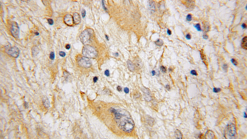 Immunohistochemical of paraffin-embedded human gliomas using Catalog No:110832(Galc antibody) at dilution of 1:50 (under 10x lens)
