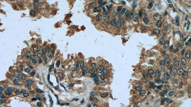 Immunohistochemistry of paraffin-embedded human prostate cancer tissue slide using Catalog No:110172(EIF1 Antibody) at dilution of 1:50 (under 40x lens)