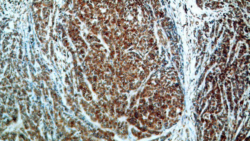 Immunohistochemical of paraffin-embedded human colon cancer using Catalog No:116452(TXNDC5 antibody) at dilution of 1:100 (under 10x lens)