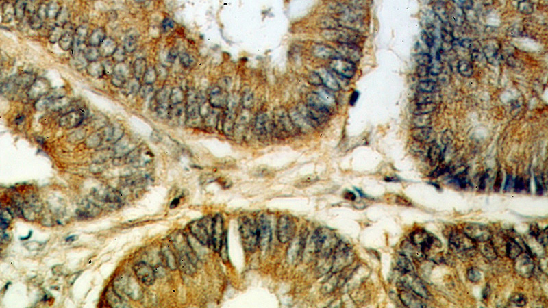 Immunohistochemical of paraffin-embedded human colon cancer using Catalog No:113989(PDPN,D2-40,M2A antibody) at dilution of 1:50 (under 40x lens)