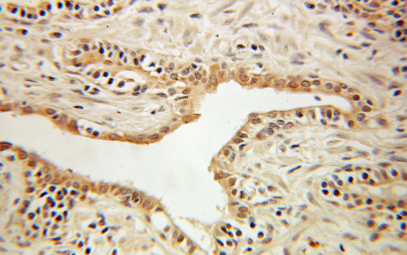 Immunohistochemical of paraffin-embedded human prostate cancer using Catalog No:117190(BLVRA antibody) at dilution of 1:100 (under 10x lens)