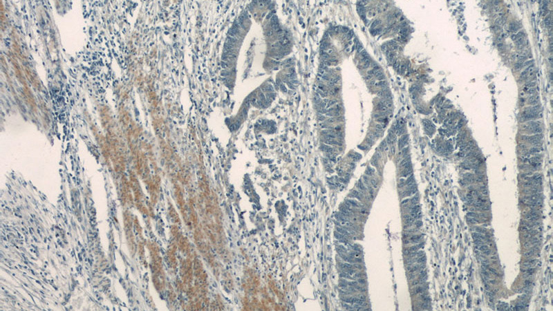 Immunohistochemistry of paraffin-embedded human colon cancer tissue slide using Catalog No:108012(AMTN Antibody) at dilution of 1:50 (under 10x lens)