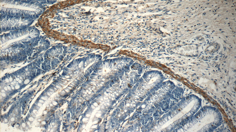 Immunohistochemistry of paraffin-embedded human colon slide using Catalog No:110459(FAM111B Antibody) at dilution of 1:50