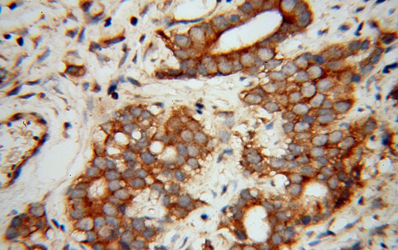 Immunohistochemical of paraffin-embedded human gliomas using Catalog No:110269(EIF5B antibody) at dilution of 1:100 (under 40x lens)