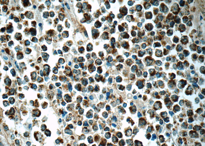 Immunohistochemistry of paraffin-embedded human lymphoma tissue slide using Catalog No:108382(BCAT1 Antibody) at dilution of 1:50 (under 40x lens)