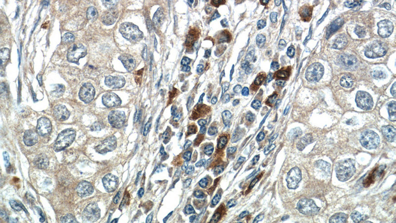 Immunohistochemistry of paraffin-embedded human breast cancer tissue slide using Catalog No:111831(IRF1 Antibody) at dilution of 1:50 (under 40x lens)