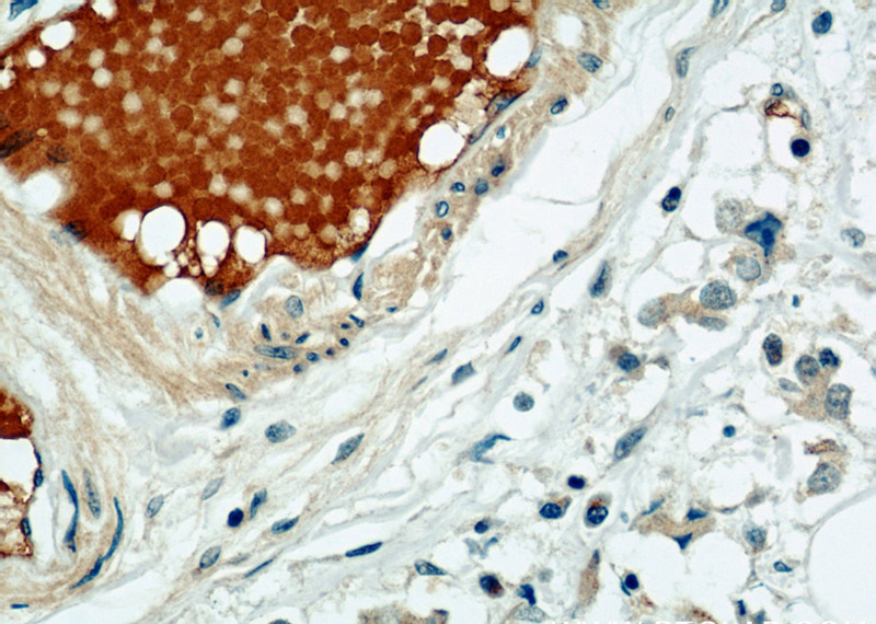 Immunohistochemical of paraffin-embedded human breast cancer using Catalog No:115824(SULF2 antibody) at dilution of 1:50 (under 40x lens)