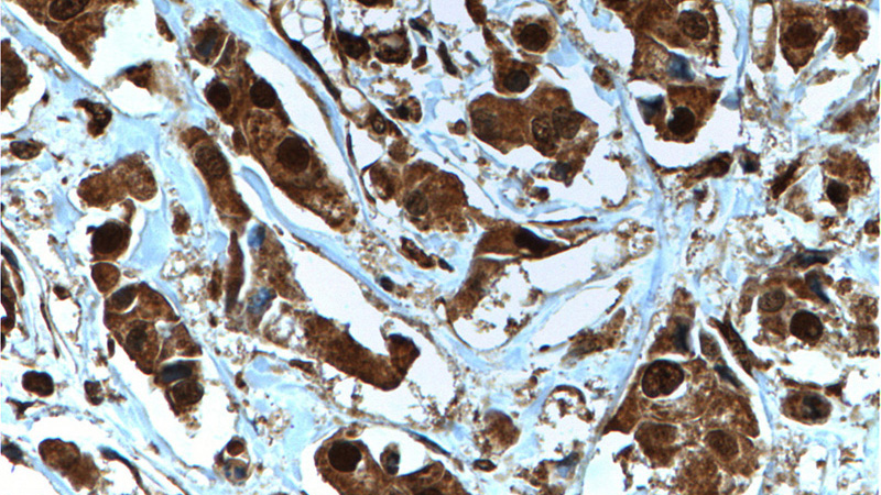 Immunohistochemistry of paraffin-embedded human breast cancer tissue slide using Catalog No:107334(NOB1 Antibody) at dilution of 1:200 (under 40x lens). heat mediated antigen retrieved with Tris-EDTA buffer(pH9).